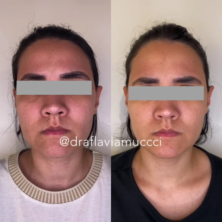 Antes e depois, acne, caso publicado pela Dra. Flávia
