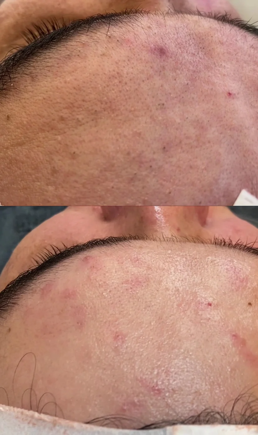 Antes e depois, acne, caso publicado pela Dra. Flávia