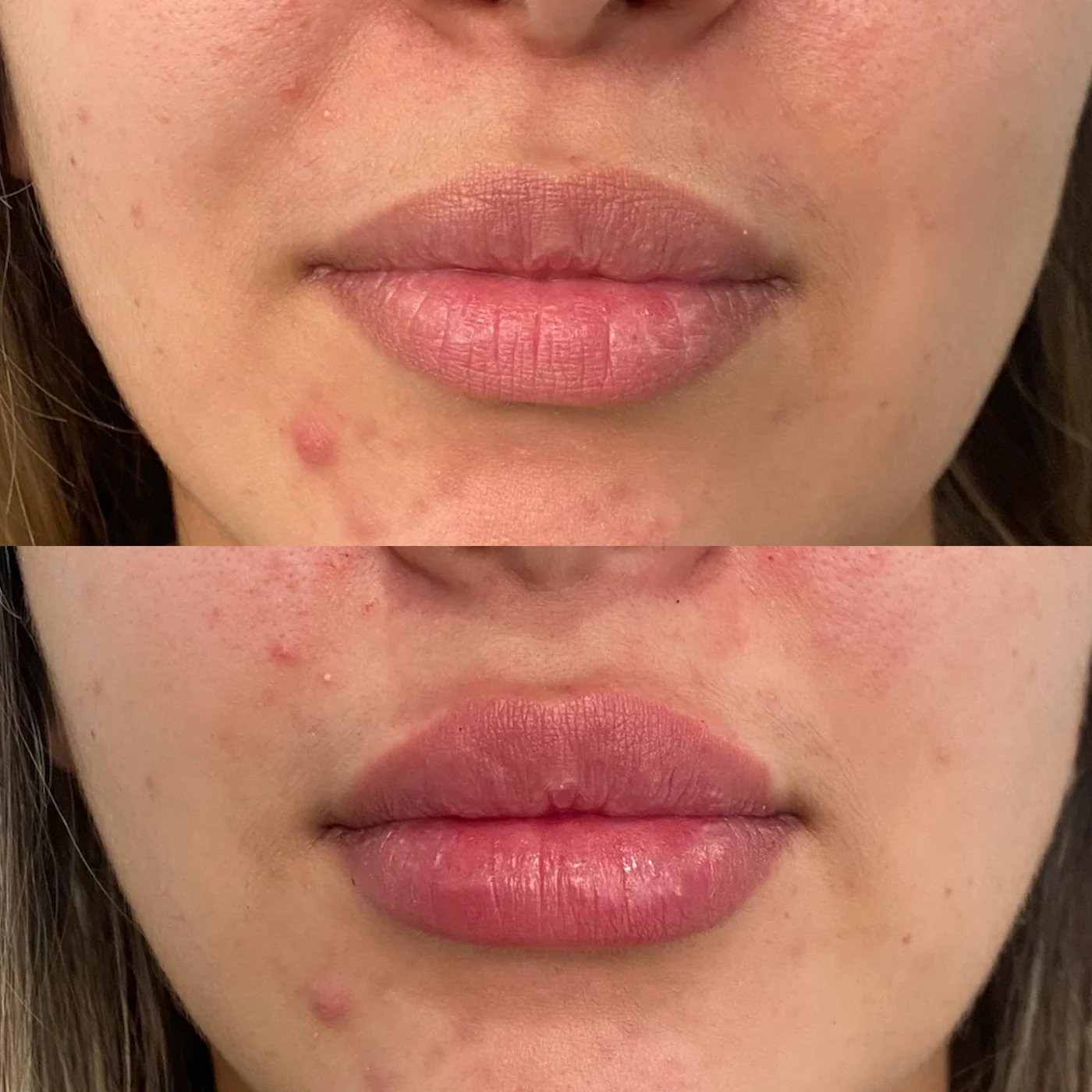 Antes e depois, acne, caso publicado pela Dra. Flávia