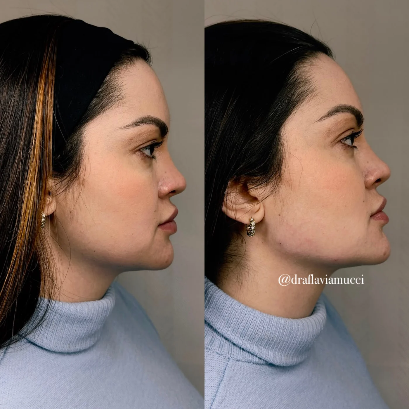 Antes e depois, contorno do rosto, caso publicado pela Dra. Flávia