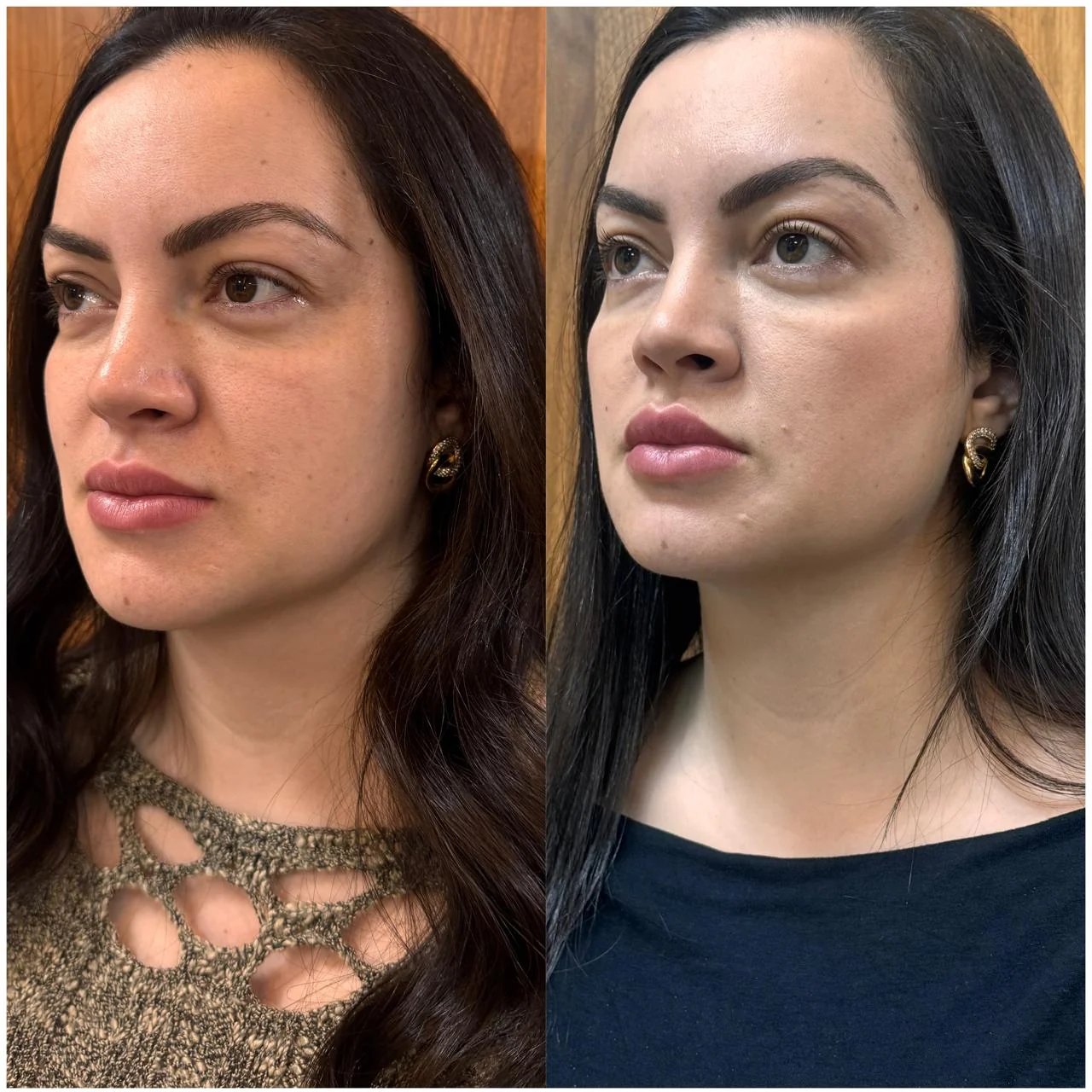 Antes e depois, contorno do rosto, caso publicado pela Dra. Flávia