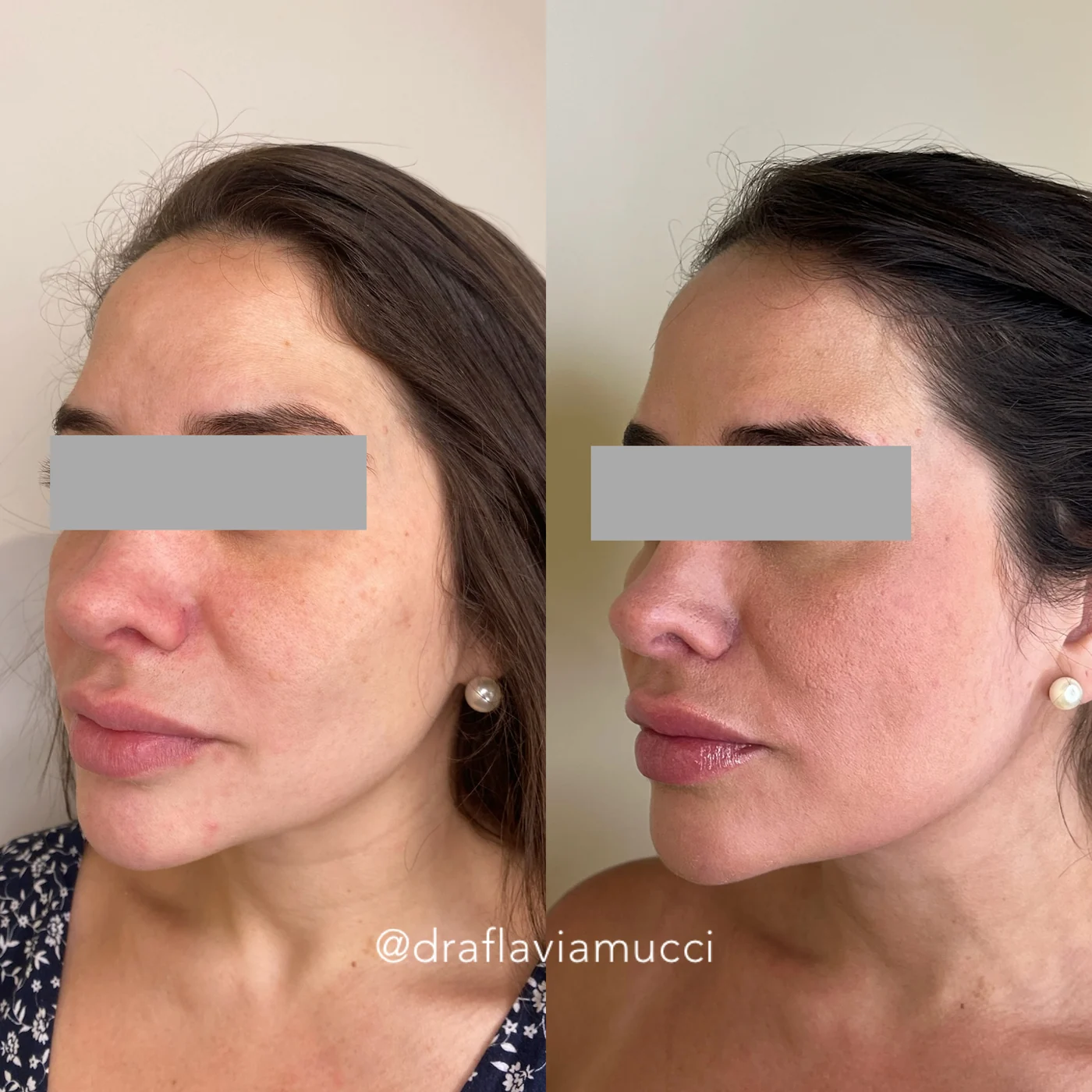 Antes e depois, contorno do rosto, caso publicado pela Dra. Flávia