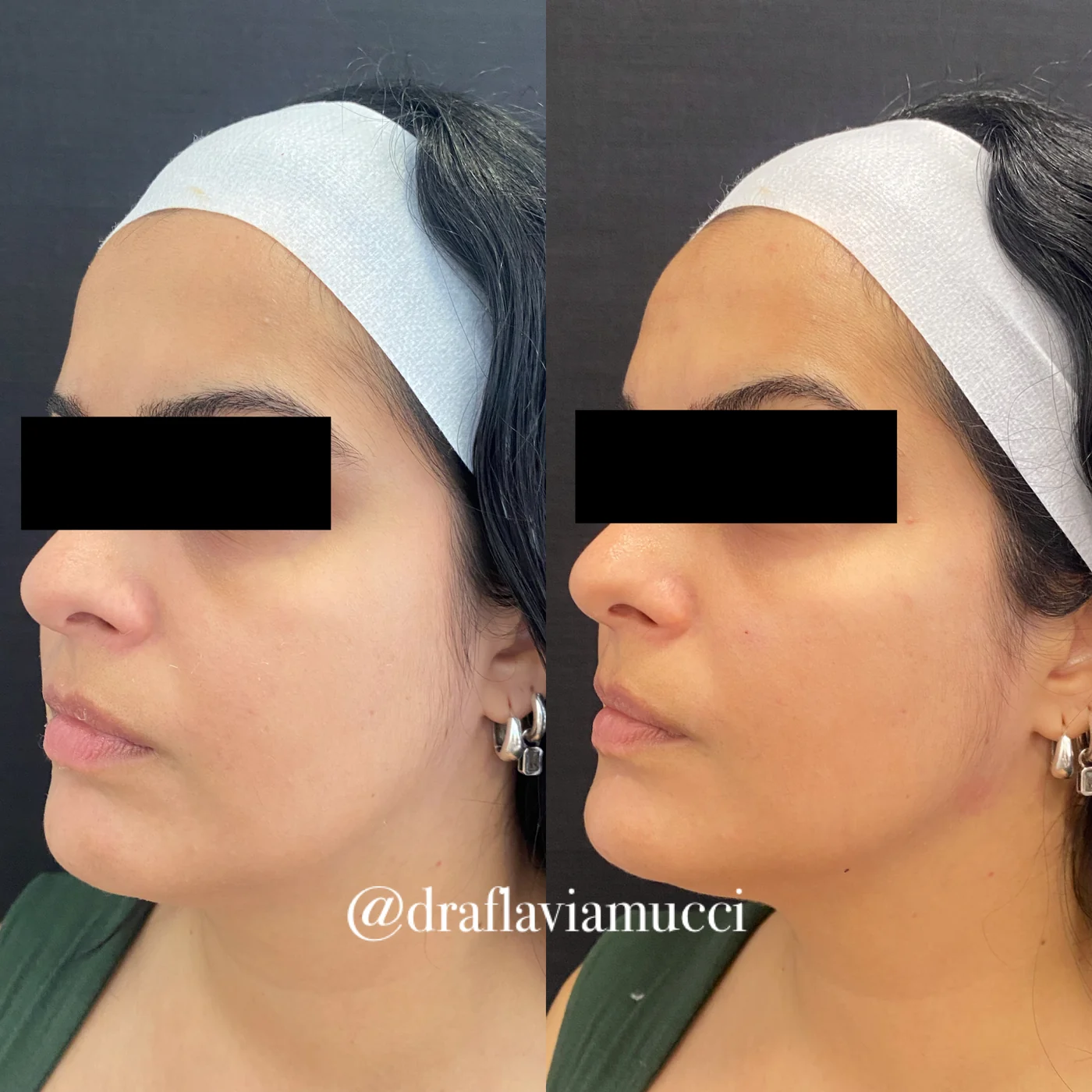 Antes e depois, contorno do rosto, caso publicado pela Dra. Flávia