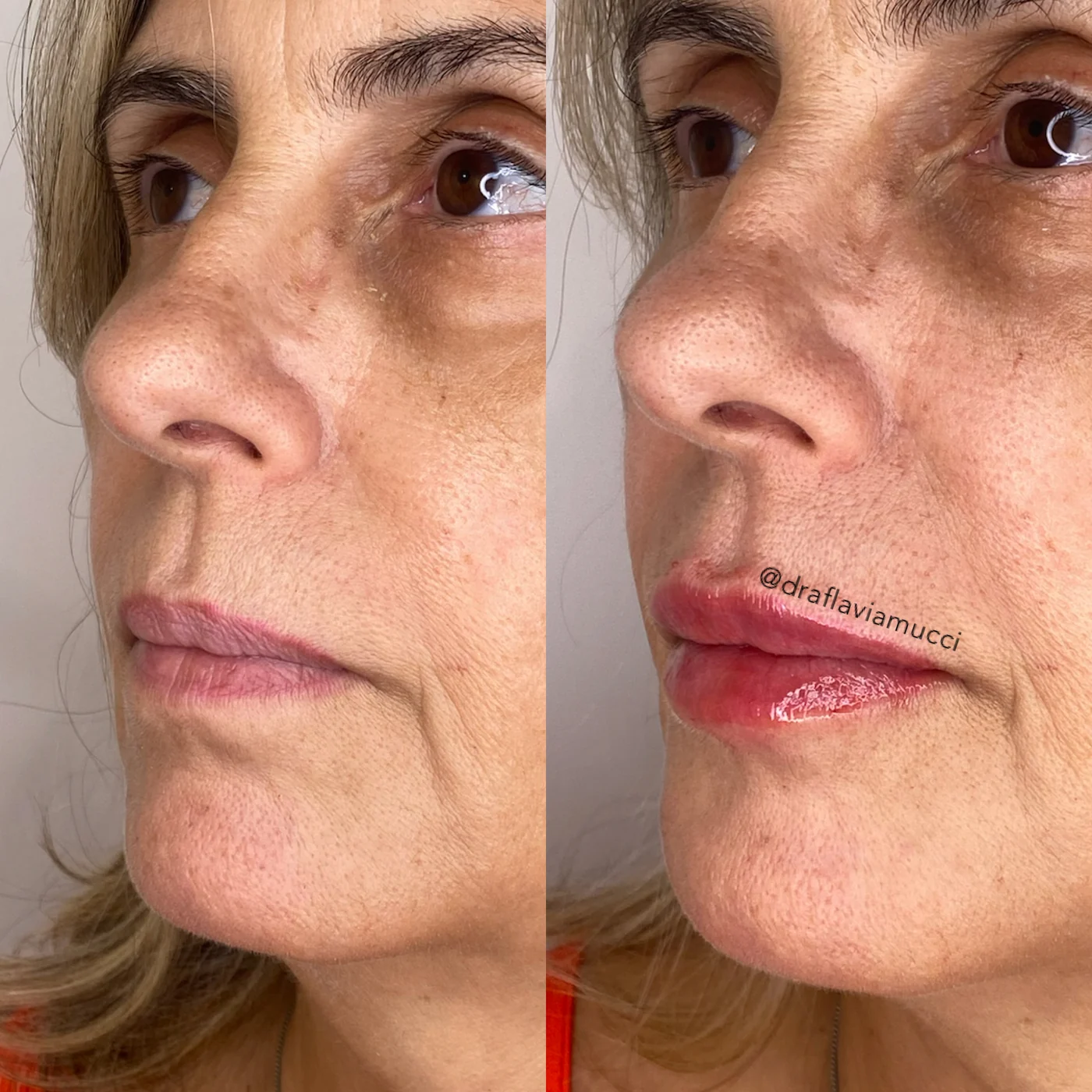 Antes e depois, lábios, caso publicado pela Dra. Flávia