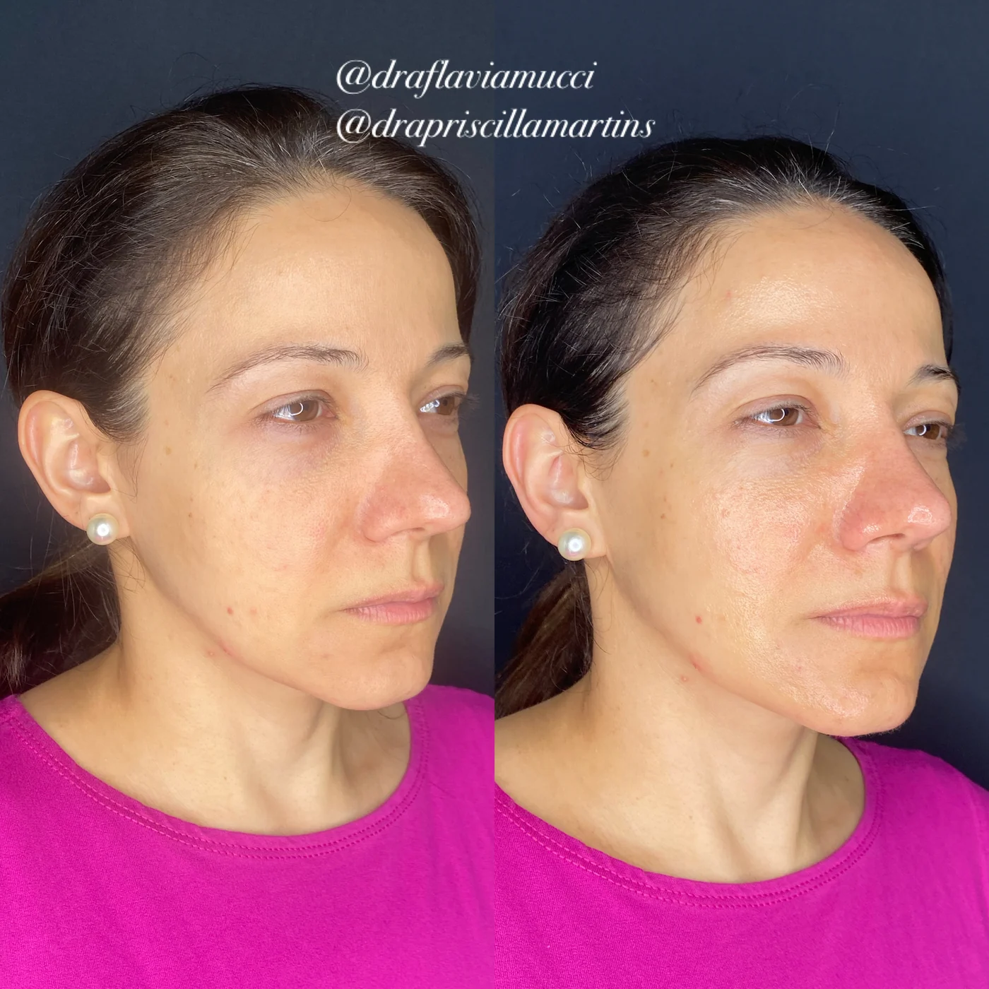 Antes e depois, firmeza e aspecto descansado, caso publicado pela Dra. Flávia
